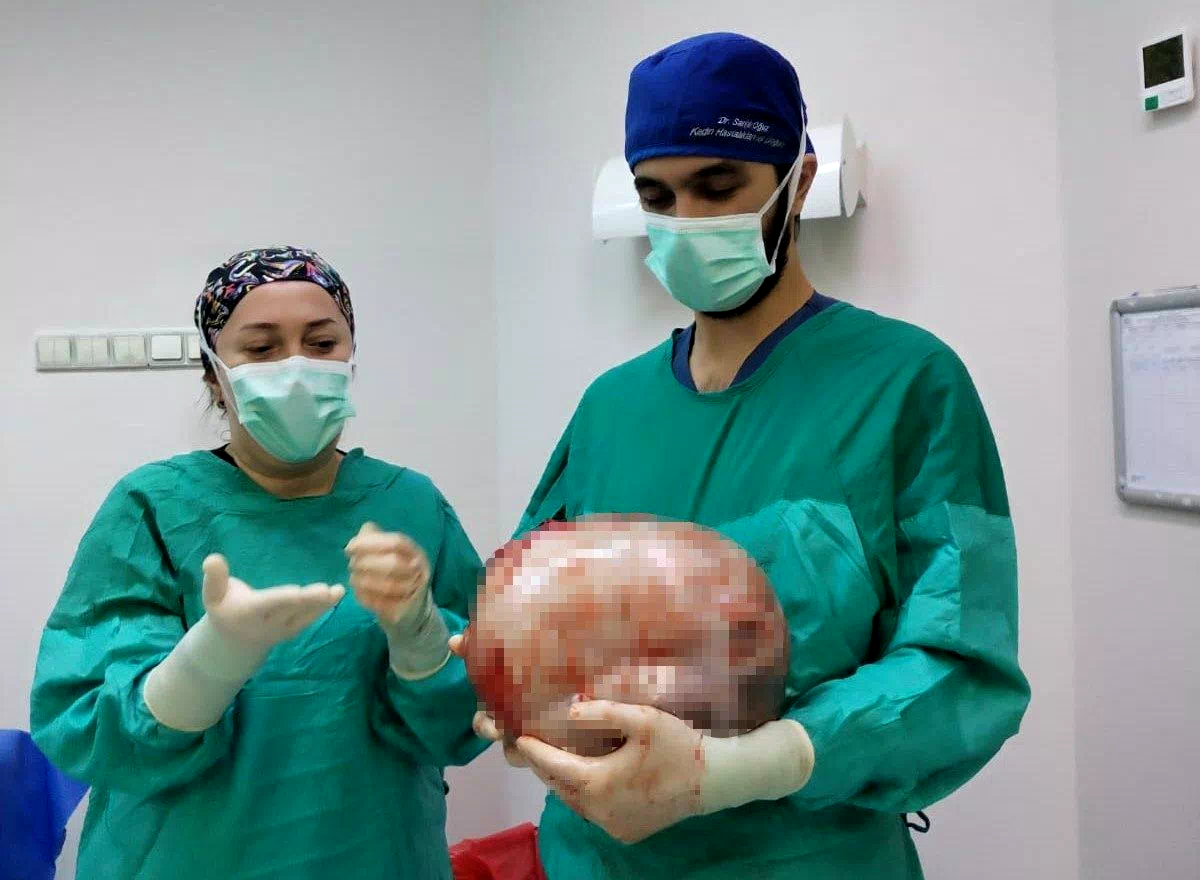 Karnı 2 ayda 9 aylık hamile gibi büyüyen kadının içinden karpuz kadar kitle çıkarıldı