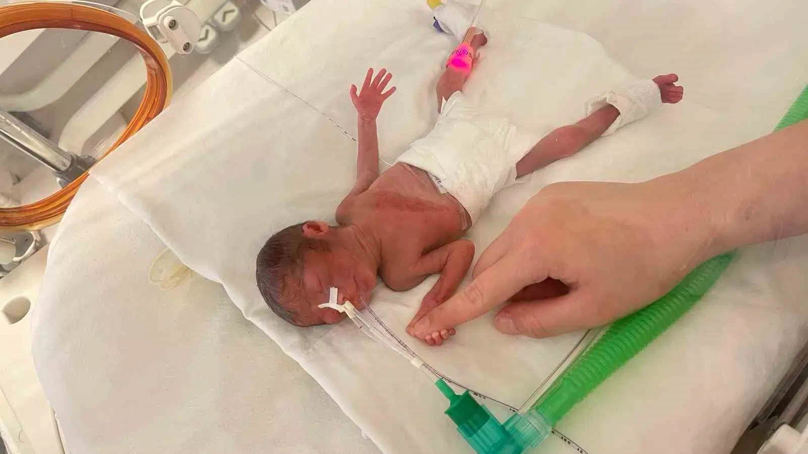 Prematüre Bebek Aylin, Yoğun Bakımdan Çıkarak Ailesine Kavuştu.