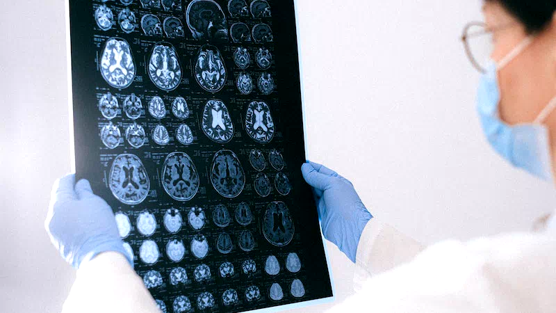 Umut veren Alzheimer ilacı! İlk kez tedavi etti