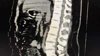 Gümüşhane'de İran uyruklu H.S.'in bağırsaklarında 271,55 gram metamfetamin ele geçirildi.