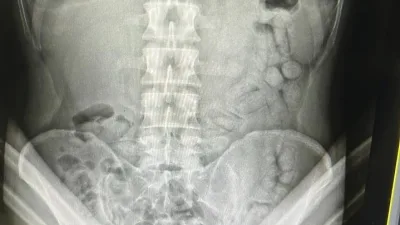 Gümüşhane polisi, İran uyruklu S.R.N.’yi durdurdu. Şahsın bağırsaklarında 55 kapsül