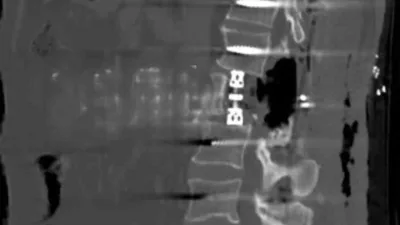 Bayburt Devlet Hastanesi'nde omurga tümörü olan hastaya başarılı bir şekilde