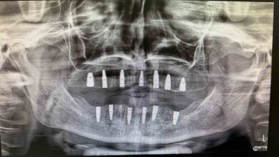 Bayburt Ağız ve Diş Sağlığı Merkezinde tamamen dişleri olmayan bir