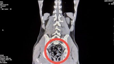 Kars’ta, İran uyruklu uyuşturucu kuryesi, makatına sakladığı 7 parça uyuşturucu