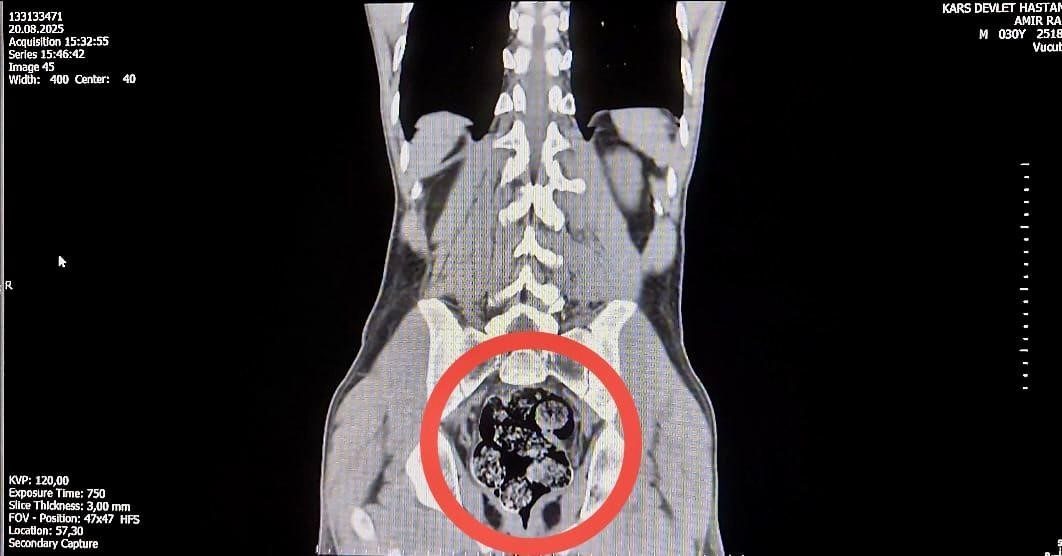 Kars’ta, İran uyruklu uyuşturucu kuryesi, makatına sakladığı 7 parça uyuşturucu