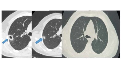 Bayburt Devlet Hastanesine öksürük ve balgam şikayetiyle başvuran 50 yaşındaki