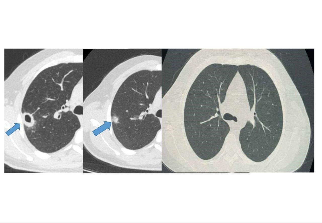 Bayburt Devlet Hastanesine öksürük ve balgam şikayetiyle başvuran 50 yaşındaki
